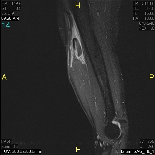Figure 2 for case Rupture of tendon of long head of biceps brachii ( RID1944 )